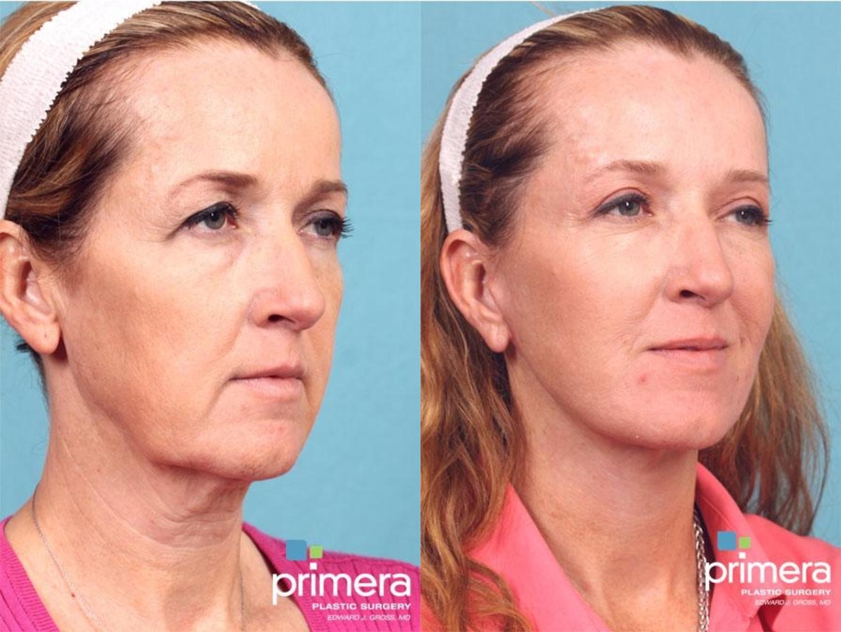 Mini Facelift Before After Photo Gallery Orlando Florida Primera Plastic Surgery