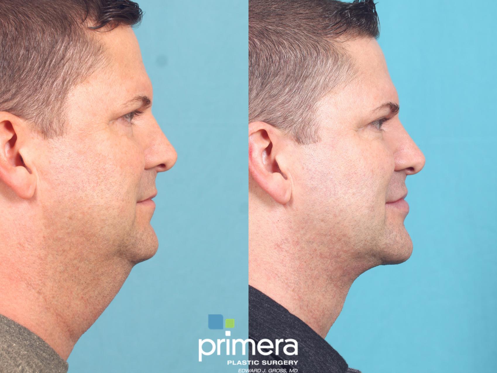 Before & After Neck Lift Case 671 Right Side View in Orlando, Florida