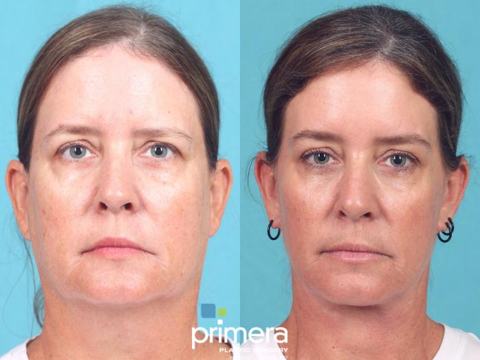 Before & After Mini Facelift Case 812 Front View in Orlando, Florida