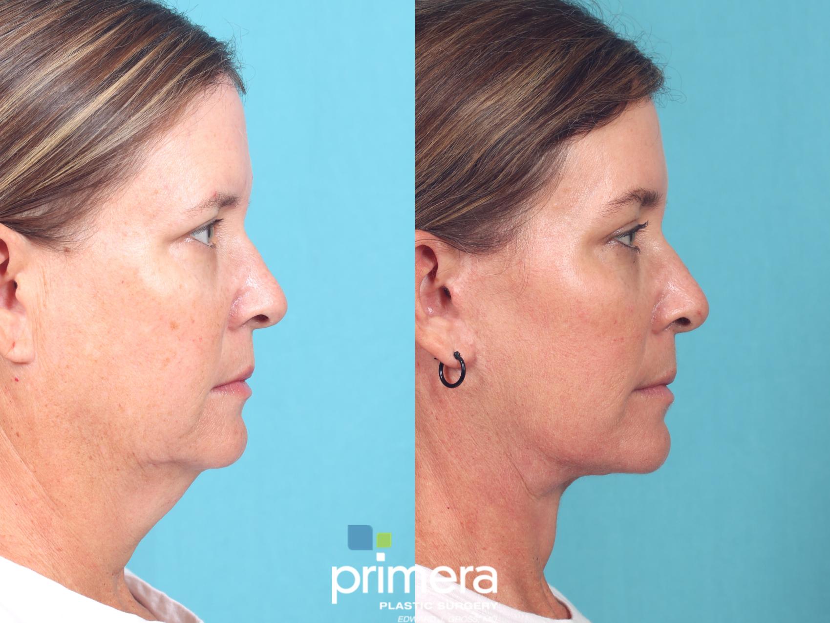 Before & After Neck Lift Case 812 Right Side View in Orlando, Florida