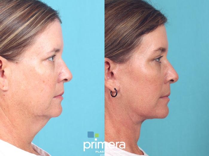 Before & After Endoscopic Forehead Lift Case 812 Right Side View in Orlando, Florida