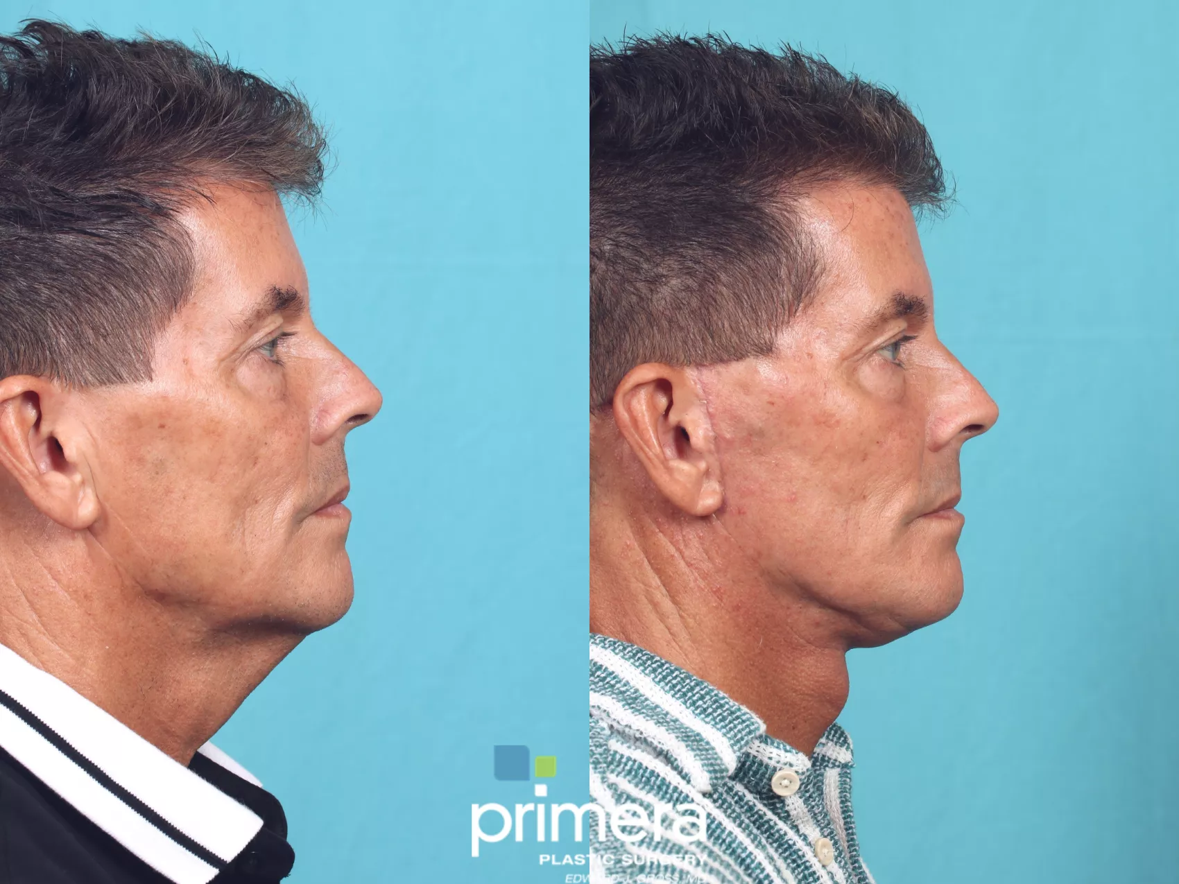 Neck Lift Before and After Pictures Case 842 | Orlando, Winter