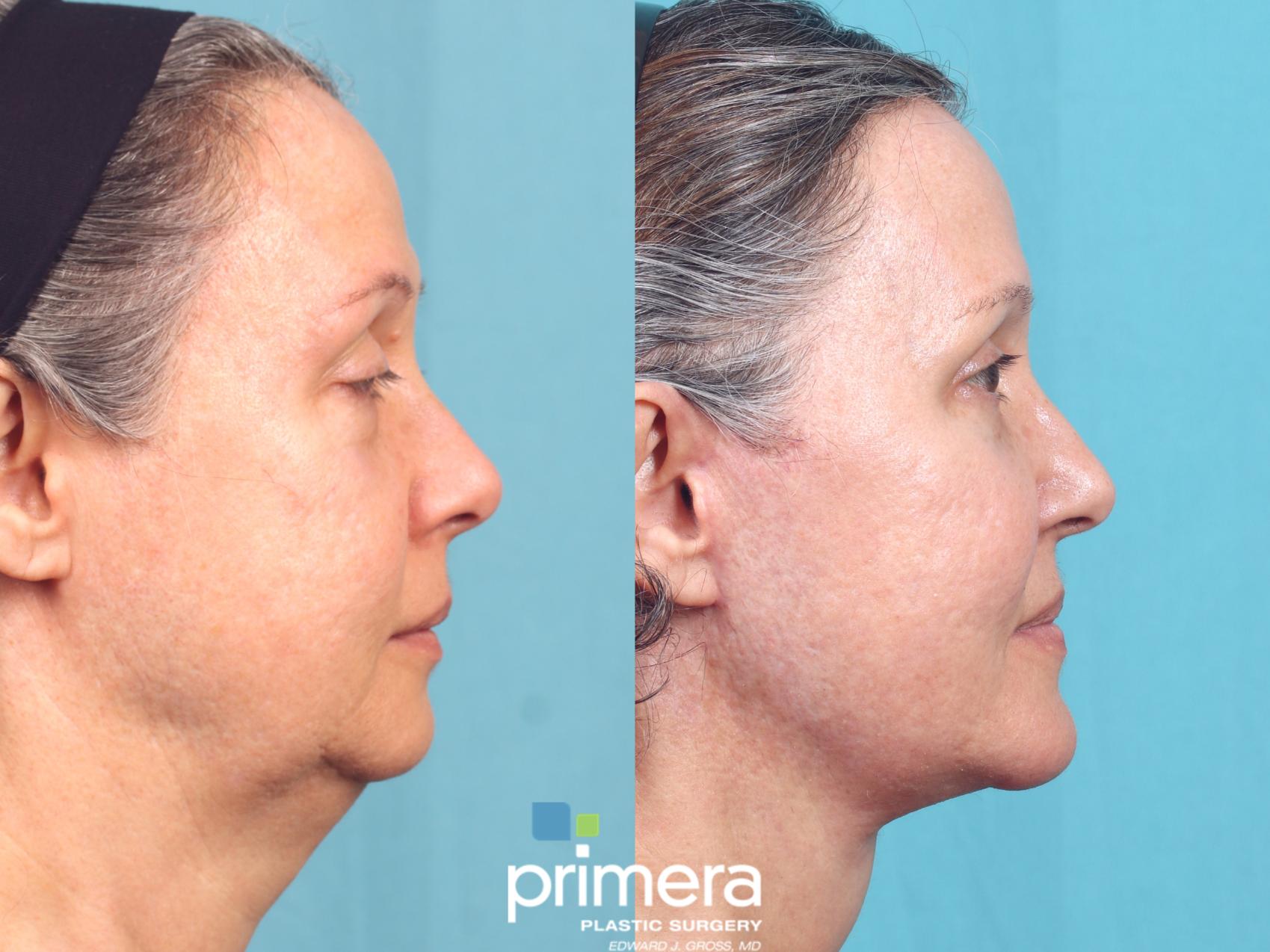 Neck Lift | Mini Lift | Chin Implant | Dr. Edward Gross | Primera Plastic Surgery