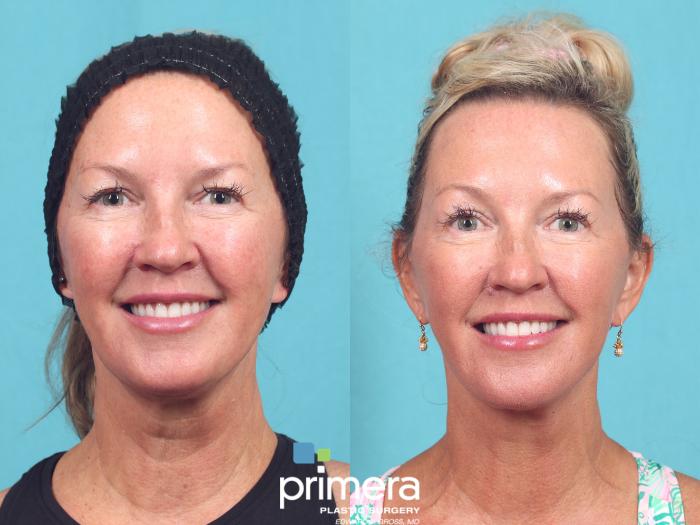 Before & After Brow Lift Case 932 Front View in Orlando, Florida