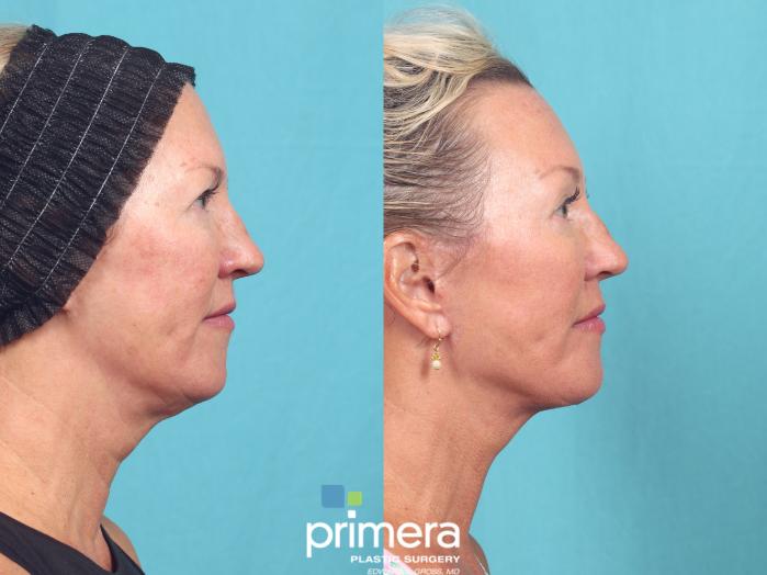 Before & After Neck Lift Case 932 Right Side View in Orlando, Florida