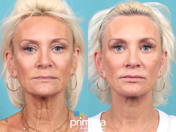 Before & After Neck Lift Case 952 Front View in Orlando, Florida