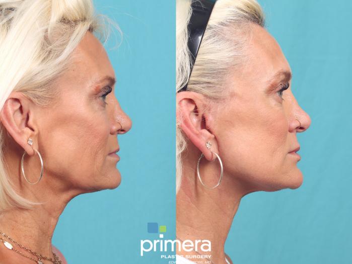 Before & After Neck Lift Case 952 Right Side View in Orlando, Florida