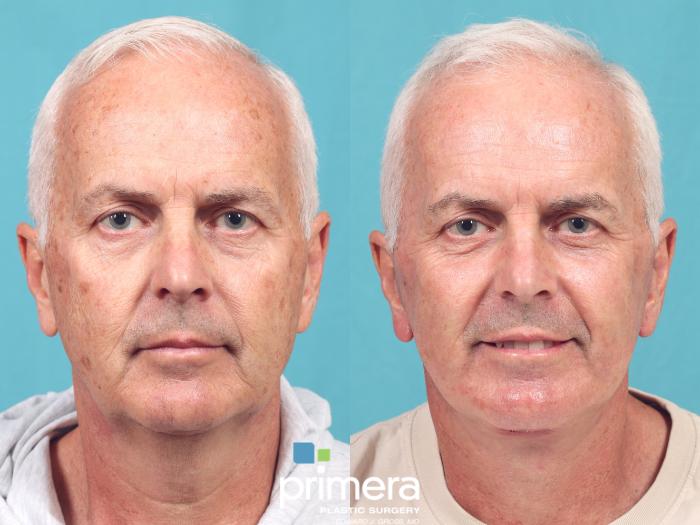 Before & After Laser Skin Resurfacing (DOT CO2) Case 991 Front View in Orlando, Winter Park & Tampa, Florida