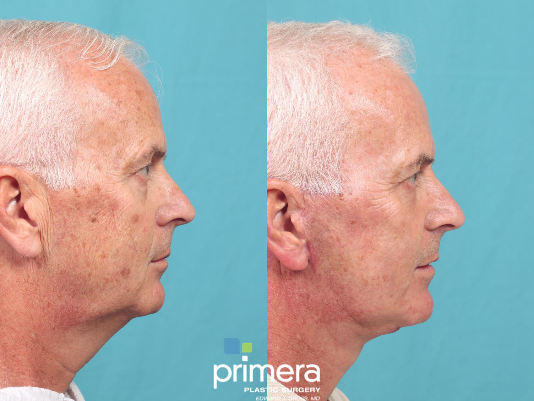 Before & After Neck Lift Case 991 Right Side View in Orlando, Florida