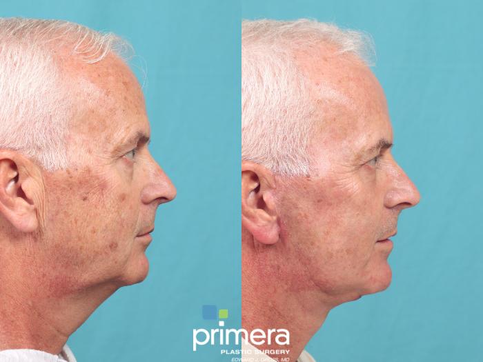 Before & After Mini Facelift Case 991 Right Side View in Orlando, Florida