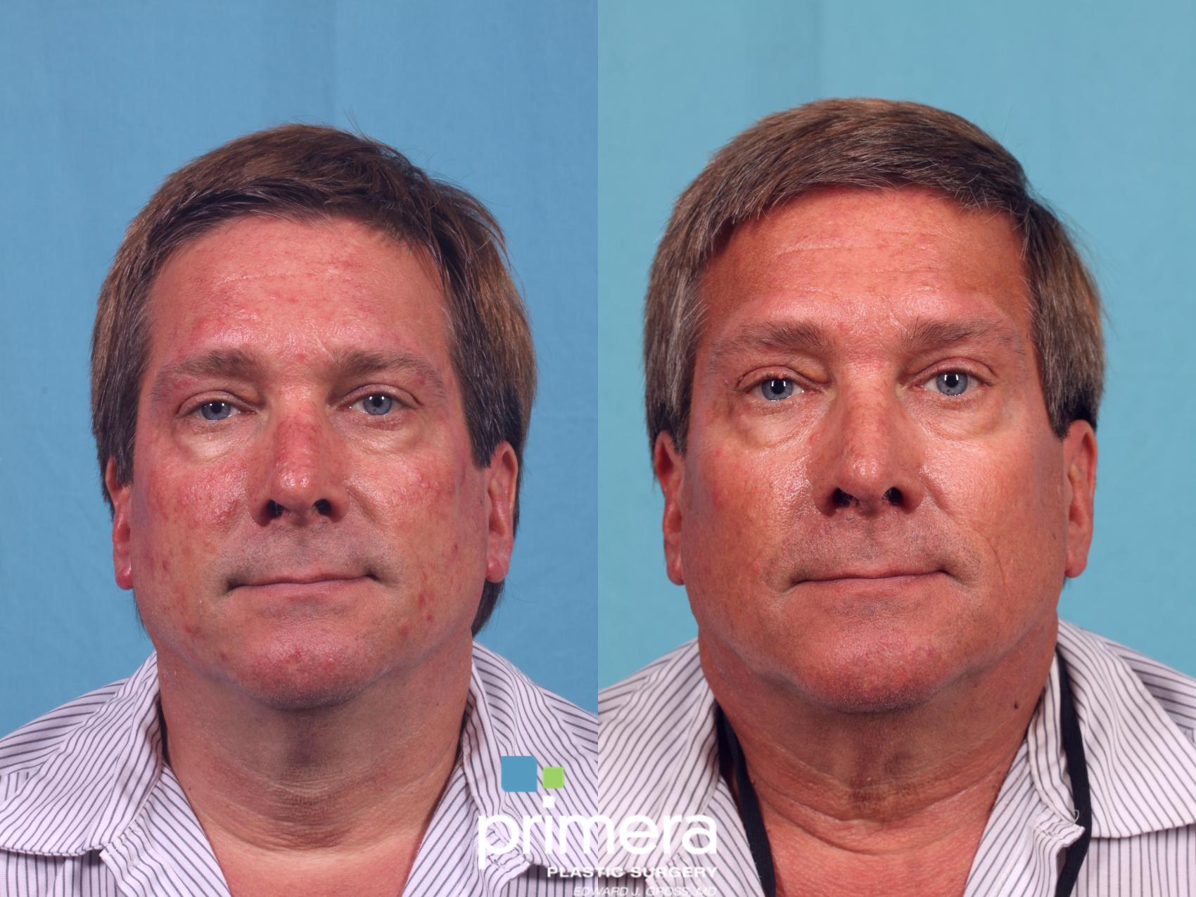 Pulsed Dye Laser Candela V Beam Before And After Pictures Case 628 Orlando Florida 