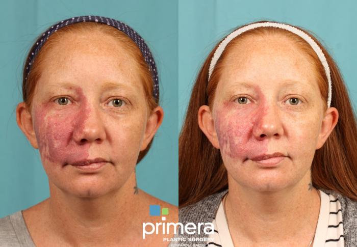 Pulse Dye Laser | Before & After | Primera Plastic Surgery | Orlando, FL