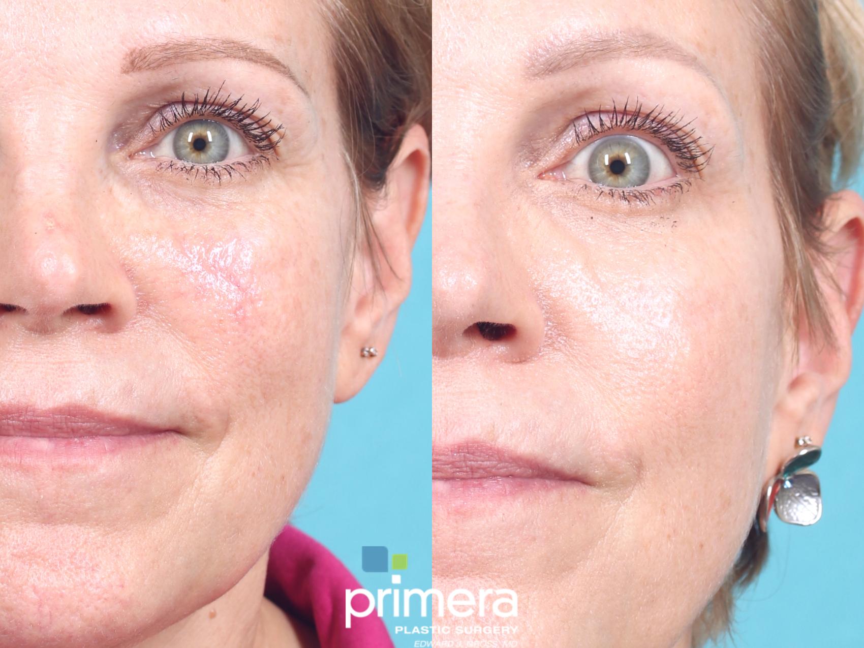 Pulsed Dye Laser (Candela VBeam) Before and After Photo Gallery