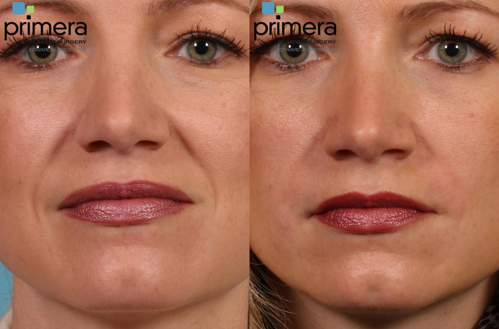 Radiesse® Before And After Pictures Case 156 Orlando Florida Primera Plastic Surgery 7093