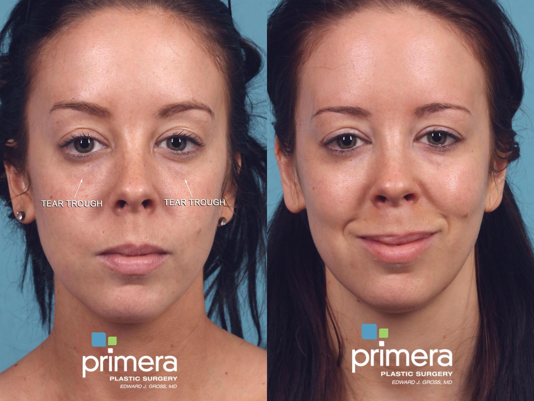 Restylane Before And After Pictures Case Orlando Florida Primera Plastic Surgery