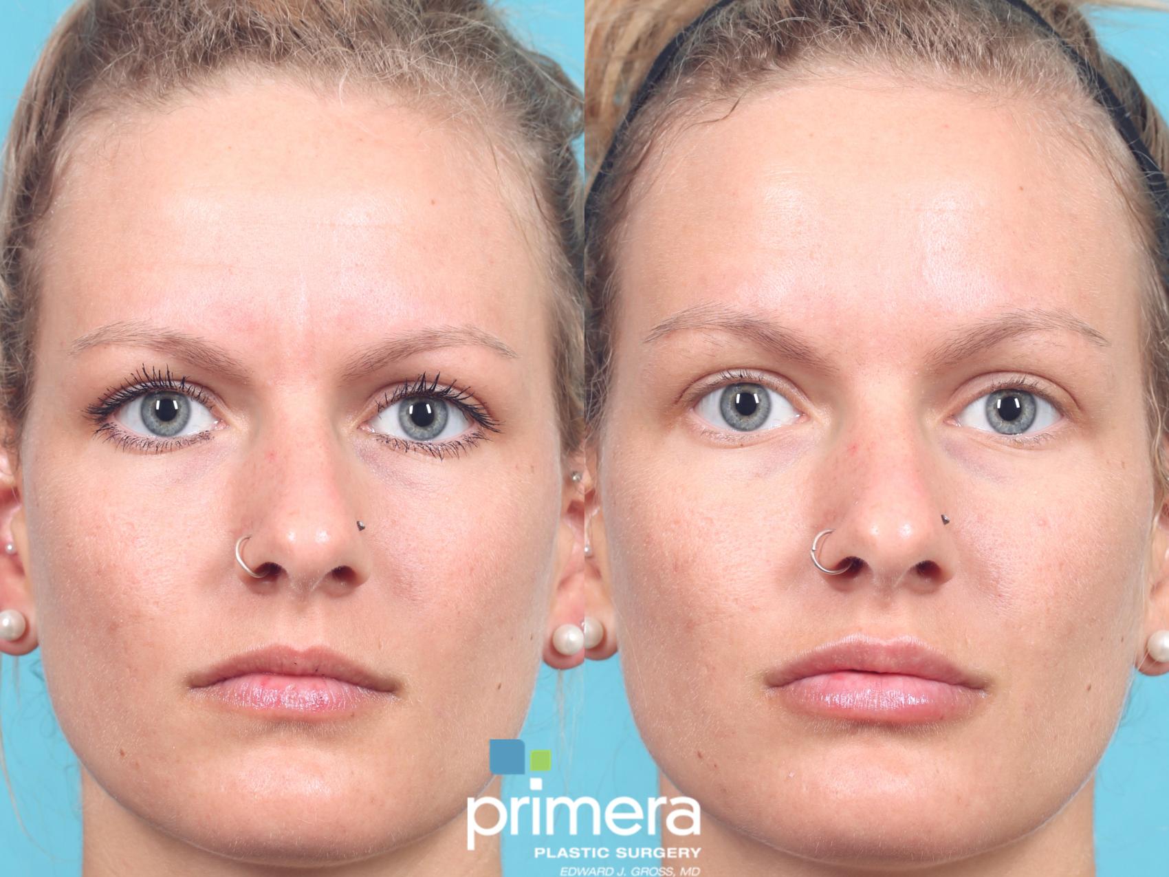 Restylane Kysse | Dr. Edward Gross | Primera Plastic Surgery | Orlando, FL