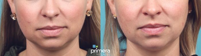Before & After Restylane® Case 958 Front View in Orlando, Florida