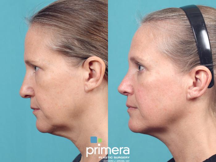 Before & After Revision Rhinoplasty Case 1017 Left Side View in Orlando, Winter Park & Tampa, Florida