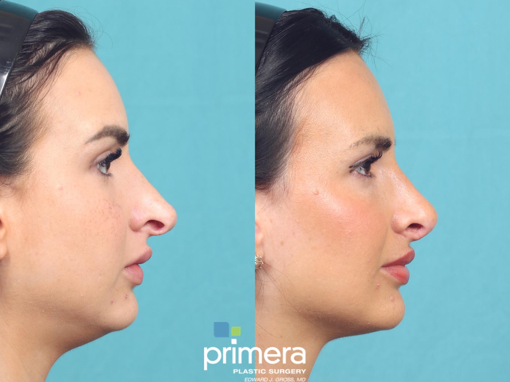 Before & After Revision Rhinoplasty Case 1049 Right Side View in Orlando, Winter Park & Tampa, Florida