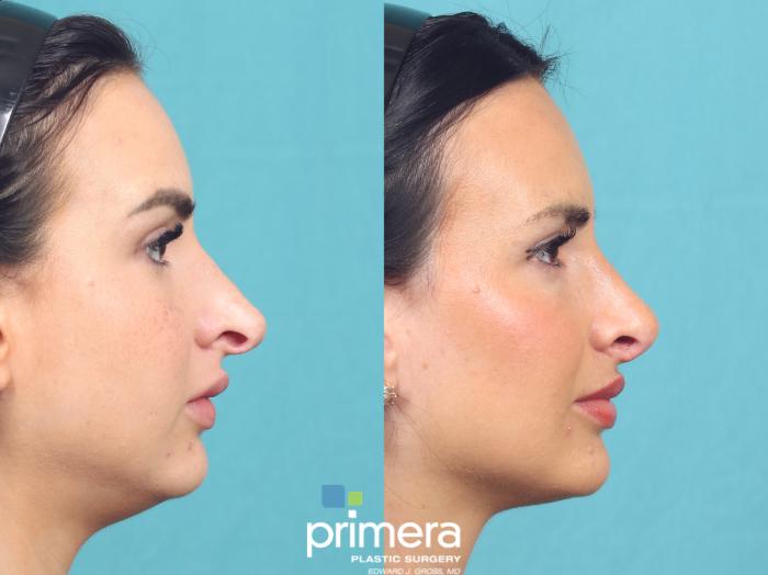 Before & After Revision Rhinoplasty Case 1049 Right Side View in Orlando, Winter Park & Tampa, Florida