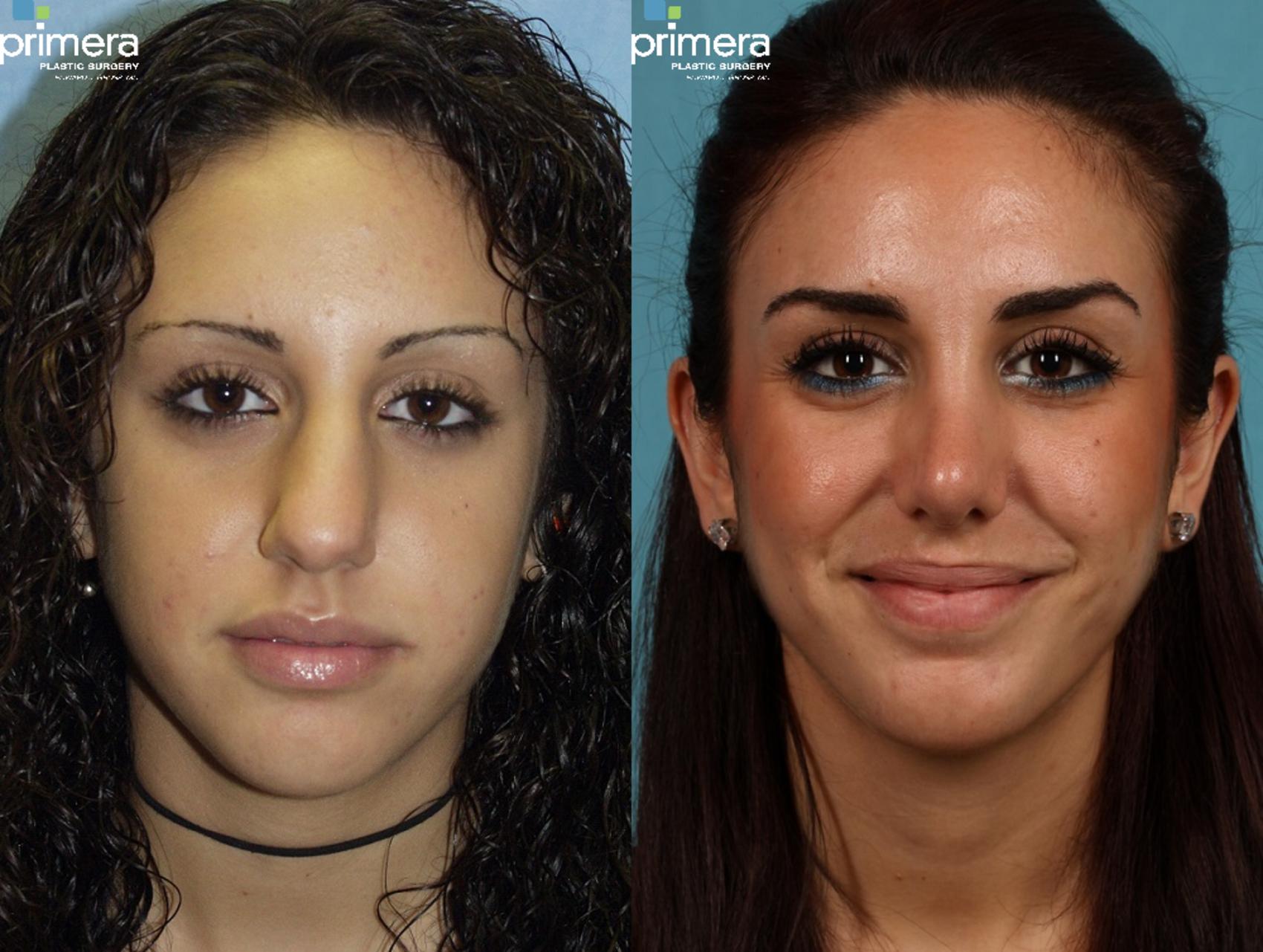 Rhinoplasty Before & After Photo Orlando, Florida Primera Plastic Surge...