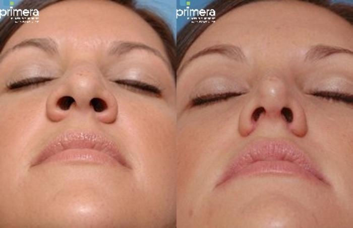 Before & After Revision Rhinoplasty Case 238 view-1 View in Orlando, Florida