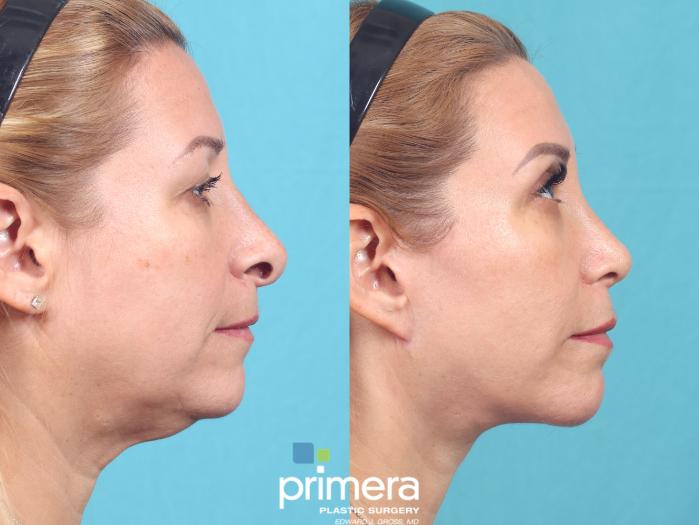 Before & After Mini Facelift Case 700 Right Side View in Orlando, Florida