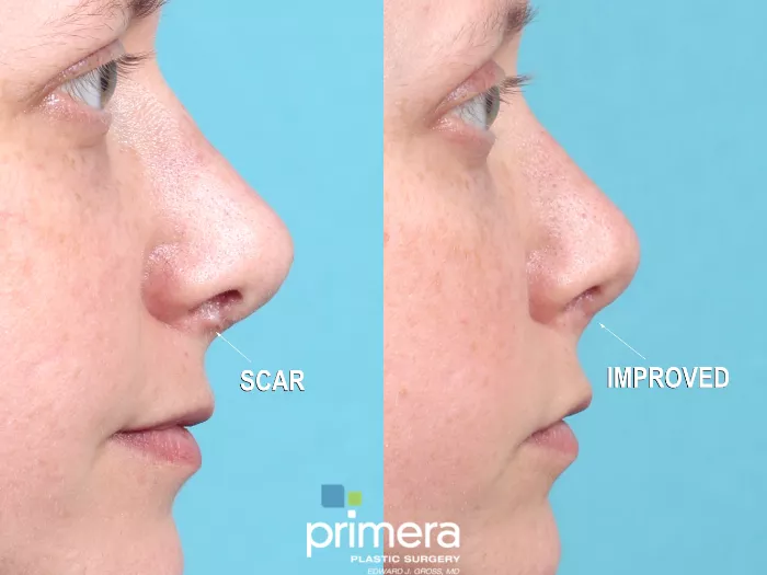 Revision Rhinoplasty Before and After Pictures Case 708 | Orlando