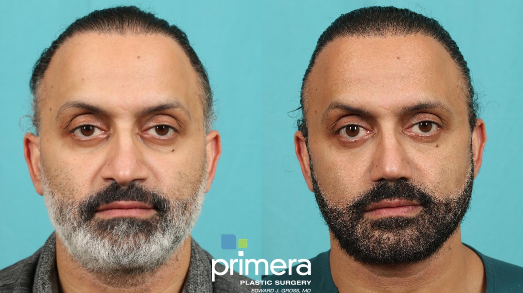 Rhinoplasty | Primera Plastic Surgery | Orlando, FL