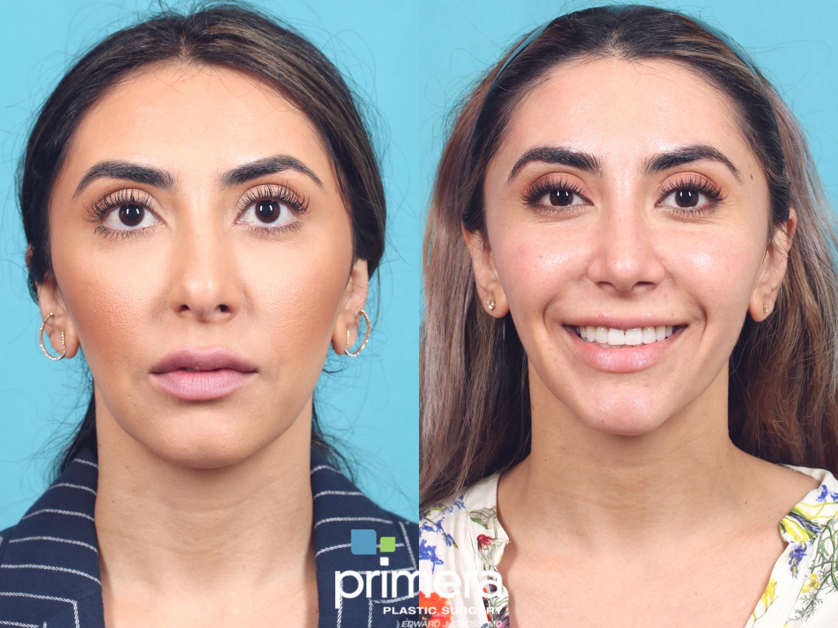 Revision Rhinoplasty | Orlando, FL