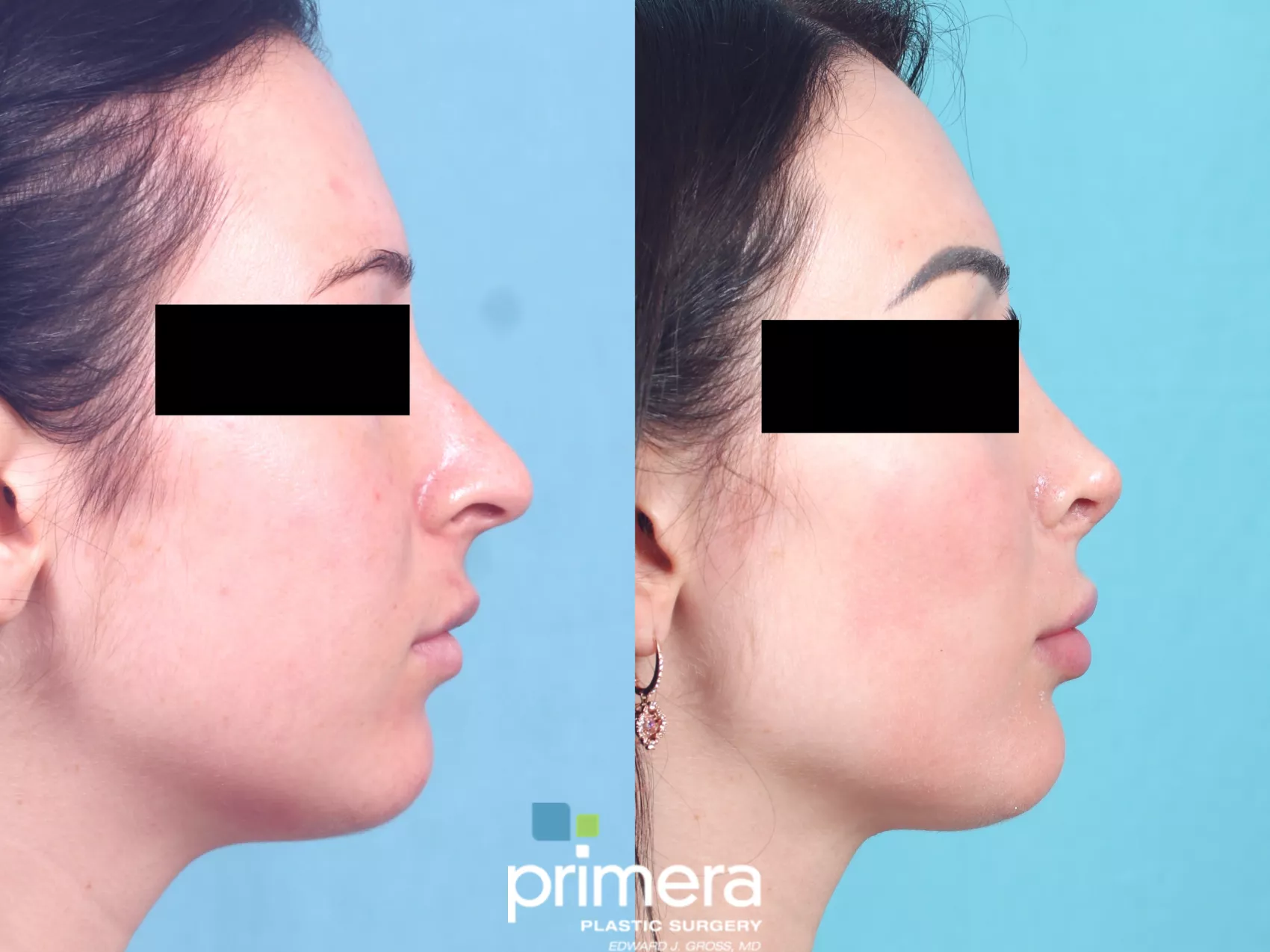 Before and After Open Rhinoplasty - Right Lateral View - Dr. Denton Before  and After Open Rhinoplasty - Right Lateral View 