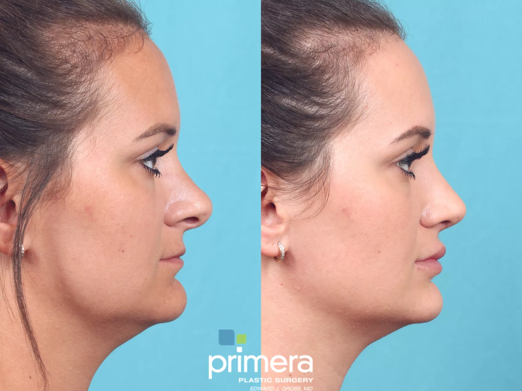revision-rhinoplasty-820-right