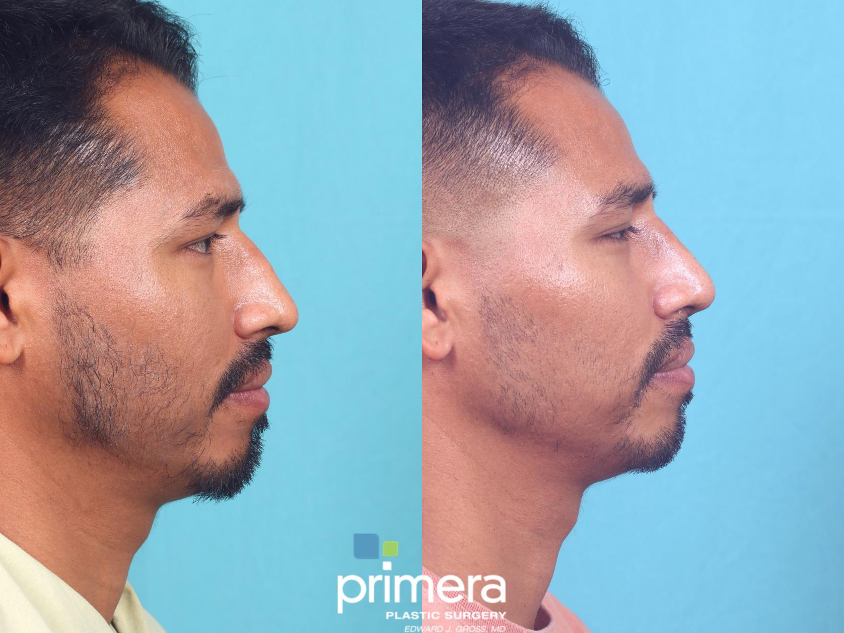 Rhinoplasty | Nose Job | Orlando , FL