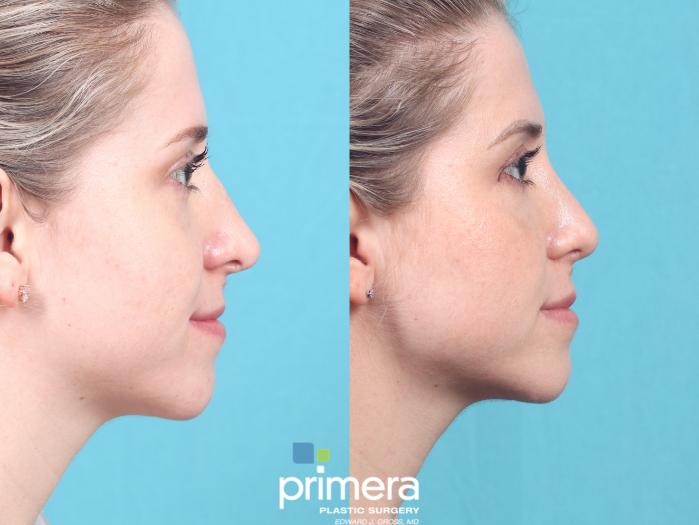 Before & After Revision Rhinoplasty Case 900 Right Side View in Orlando, Florida