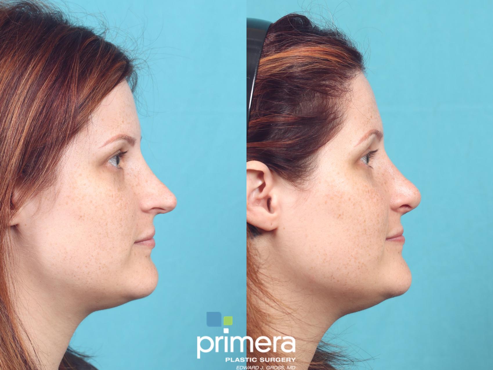 Before & After Revision Rhinoplasty Case 930 Right Side View in Orlando, Florida