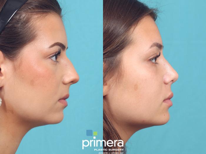Before & After Revision Rhinoplasty Case 946 Right Side View in Orlando, Florida