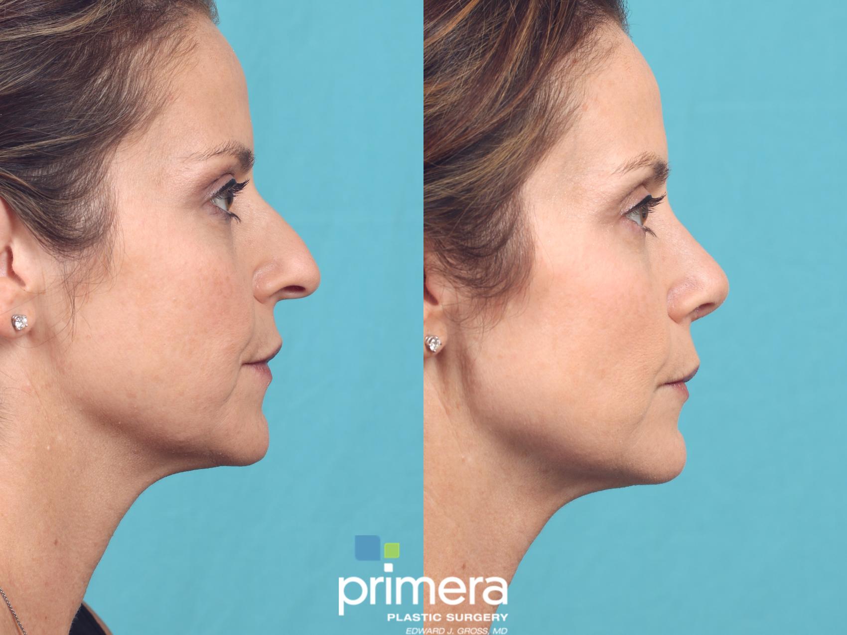 Before & After Revision Rhinoplasty Case 972 Right Side View in Orlando, Florida