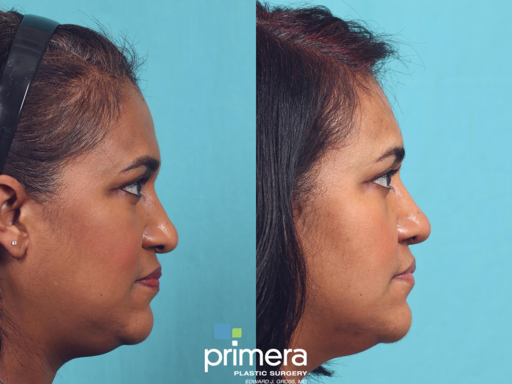 Before & After Rhinoplasty Case 975 Right Side View in Orlando, Florida