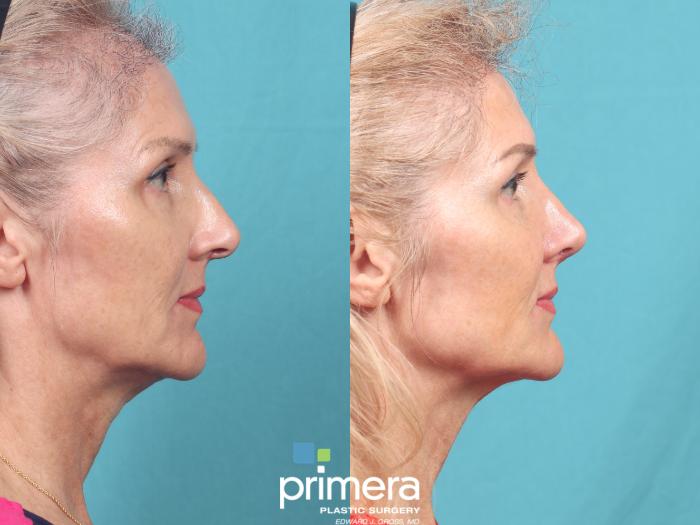 Before & After Revision Rhinoplasty Case 976 Right Side View in Orlando, Florida