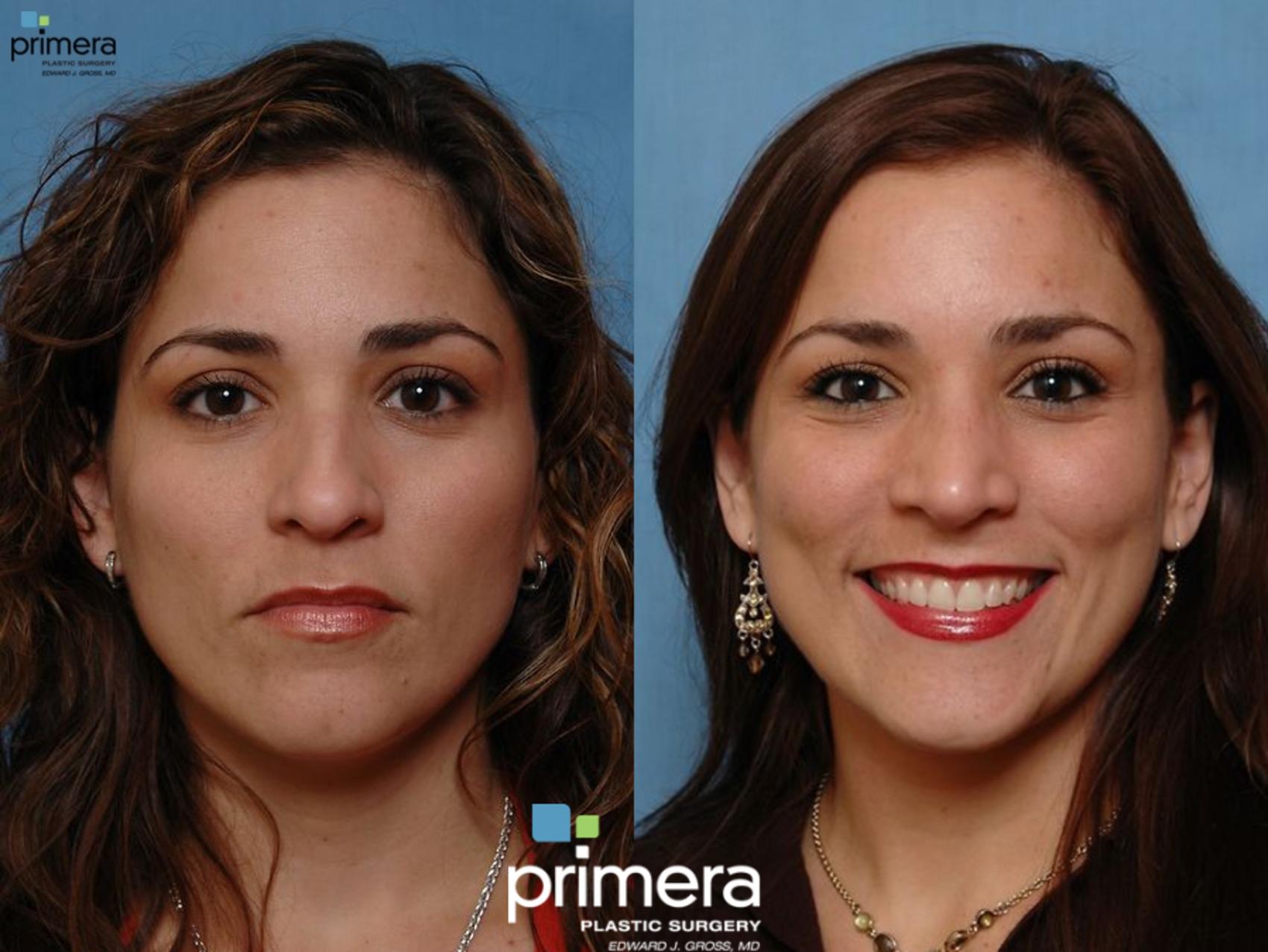 Before & After Rhinoplasty Case 10 view-1 View in Orlando, Florida