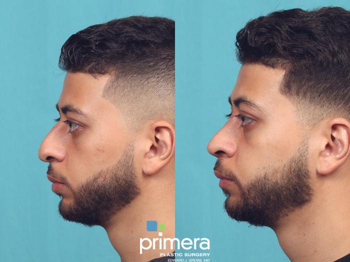 Before & After Rhinoplasty Case 1007 Left Side View in Orlando, Winter Park & Tampa, Florida