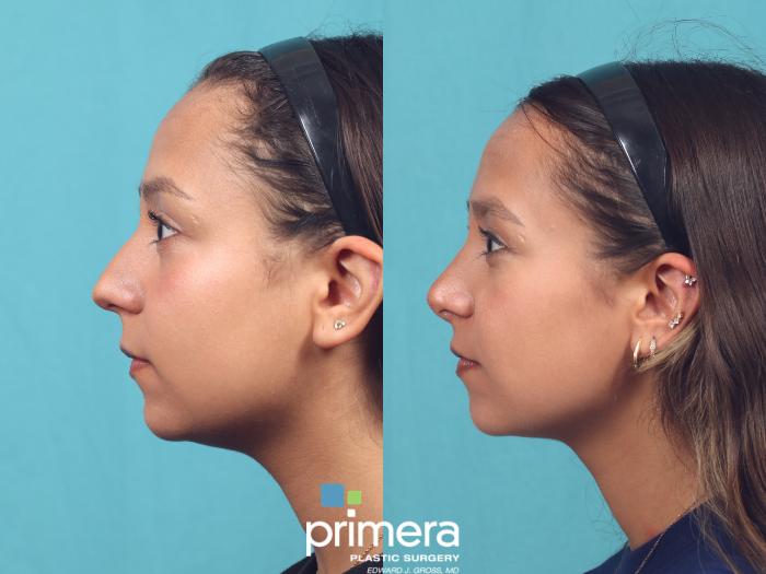 Before & After Rhinoplasty Case 1010 Left Side View in Orlando, Winter Park & Tampa, Florida