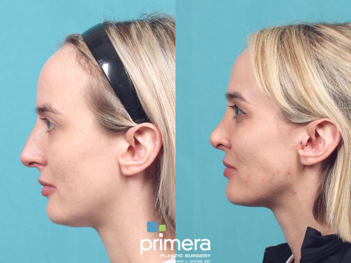 Before & After Rhinoplasty Case 1012 Left Side View in Orlando, Winter Park & Tampa, Florida