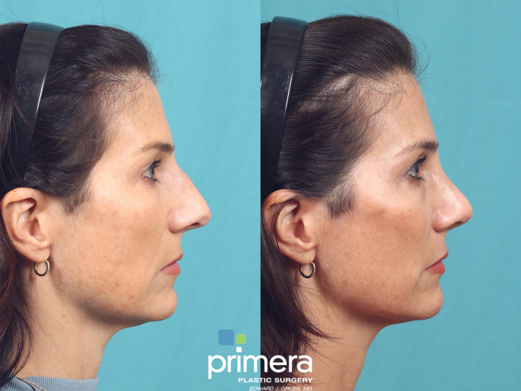 Before & After Rhinoplasty Case 1015 Right Side View in Orlando, Winter Park & Tampa, Florida