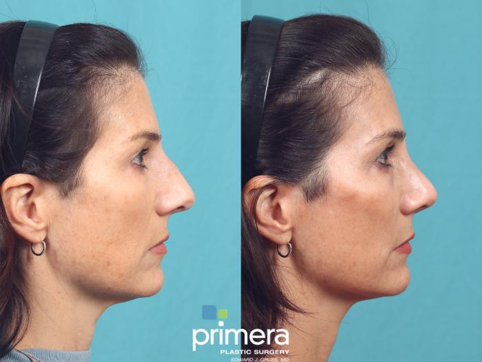 Before & After Rhinoplasty Case 1015 Right Side View in Orlando, Winter Park & Tampa, Florida