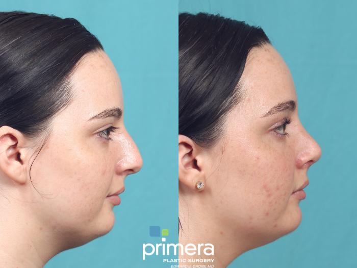 Before & After Rhinoplasty Case 1019 Right Side View in Orlando, Winter Park & Tampa, Florida