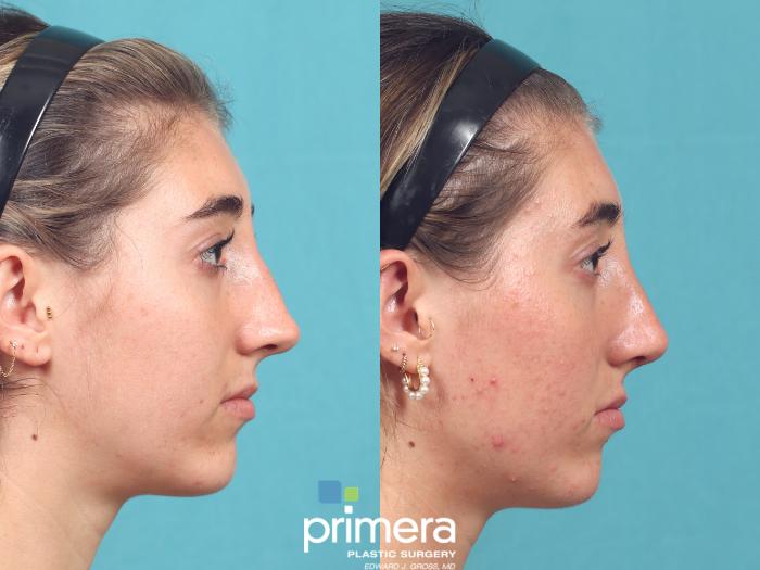 Before & After Rhinoplasty Case 1020 Right Side View in Orlando, Winter Park & Tampa, Florida