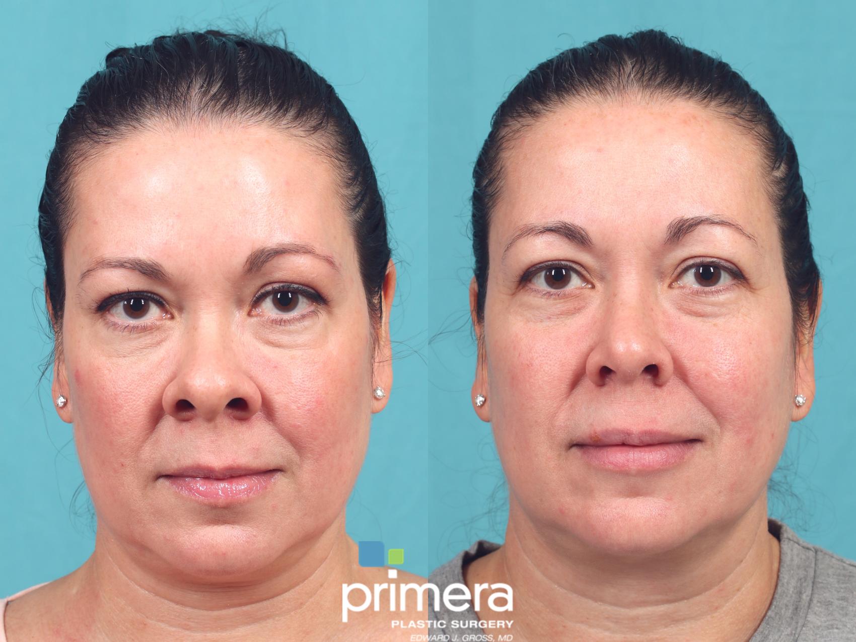 Before & After Rhinoplasty Case 1021 Front View in Orlando, Winter Park & Tampa, Florida
