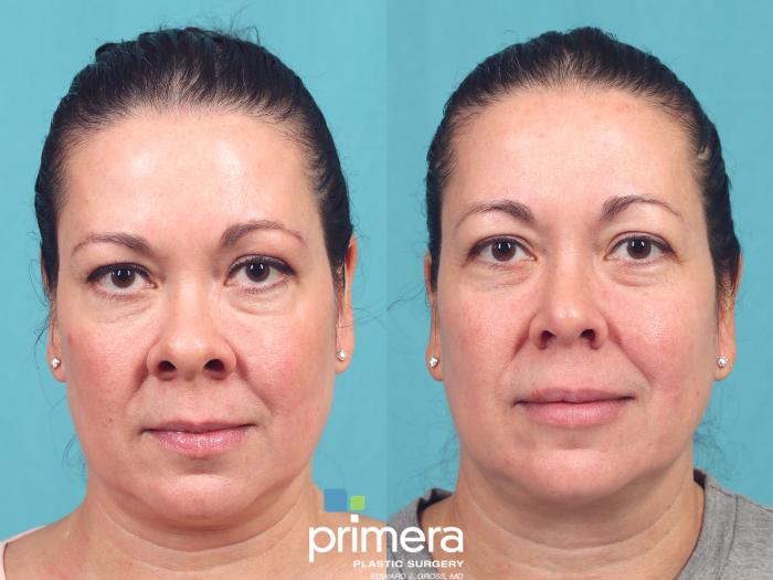Before & After Rhinoplasty Case 1021 Front View in Orlando, Winter Park & Tampa, Florida