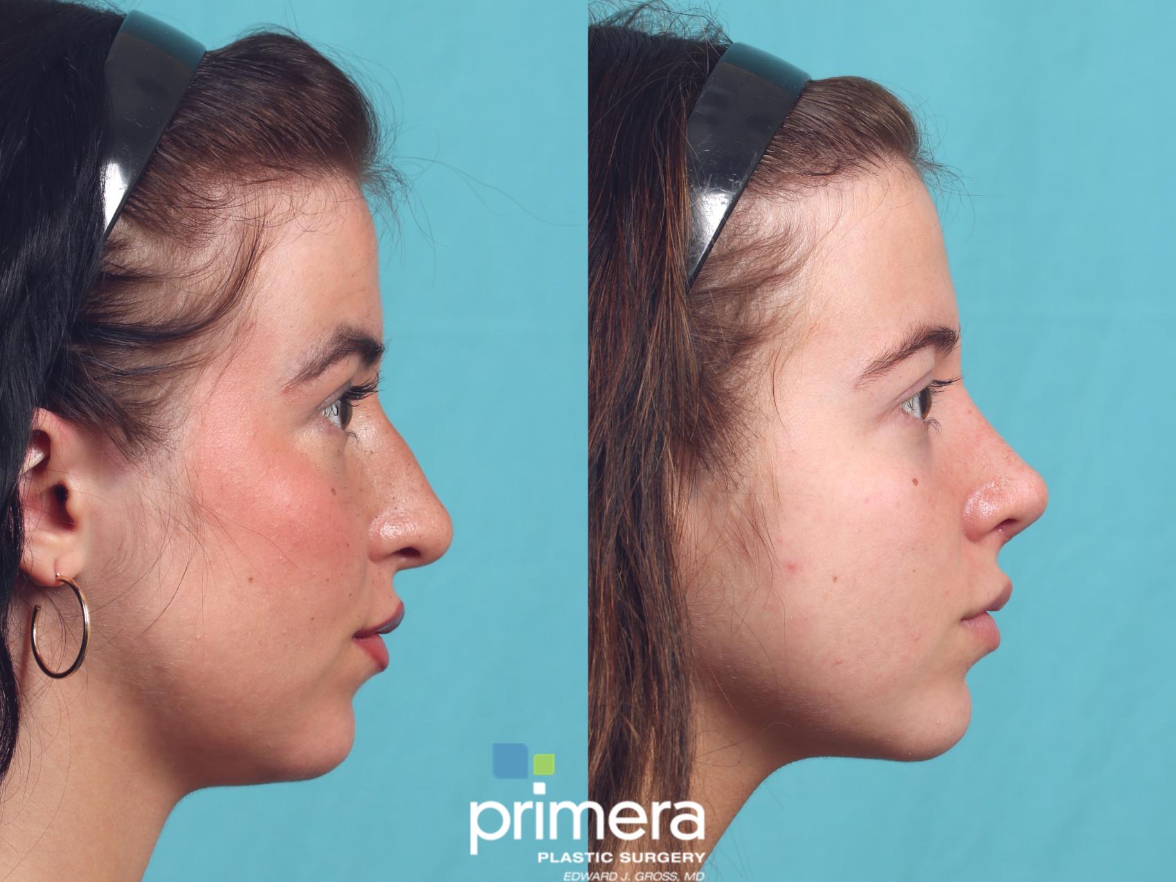 Before & After Rhinoplasty Case 1024 Right Side View in Orlando, Winter Park & Tampa, Florida